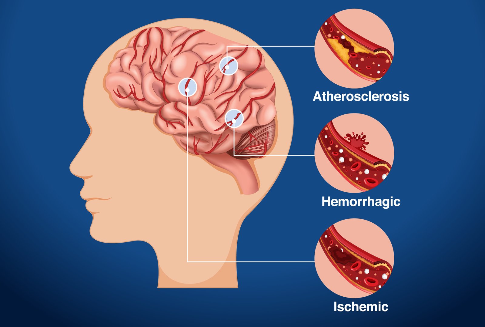 Stroke Prevention & Rehabilitation